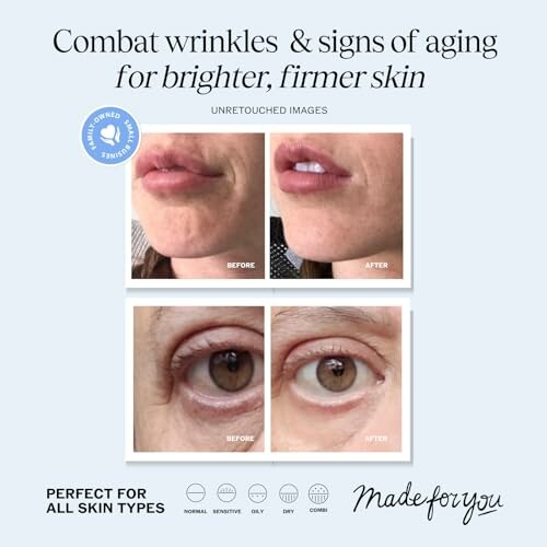 Before and after images showing reduced wrinkles and firmer skin.