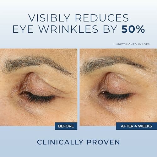 Comparison of eye wrinkles before and after treatment, showing a 50% reduction.
