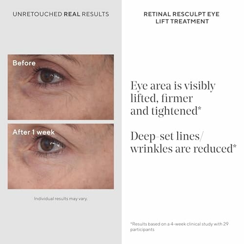 Comparison of eye area before and after retinal resculpt eye lift treatment.